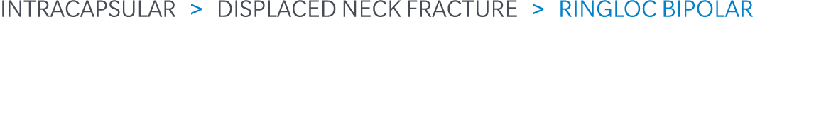 Intracapsular  Displaced Neck Fracture   Ringloc Bipolar