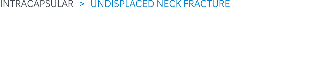 Intracapsular  Undisplaced Neck Fracture