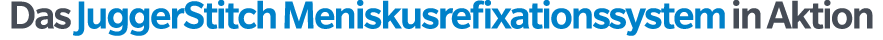 Das JuggerStitch Meniskusrefixationssystem in Aktion