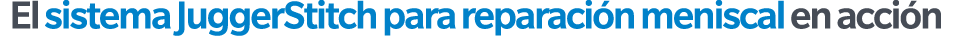 El sistema JuggerStitch para reparaci n meniscal en acci n