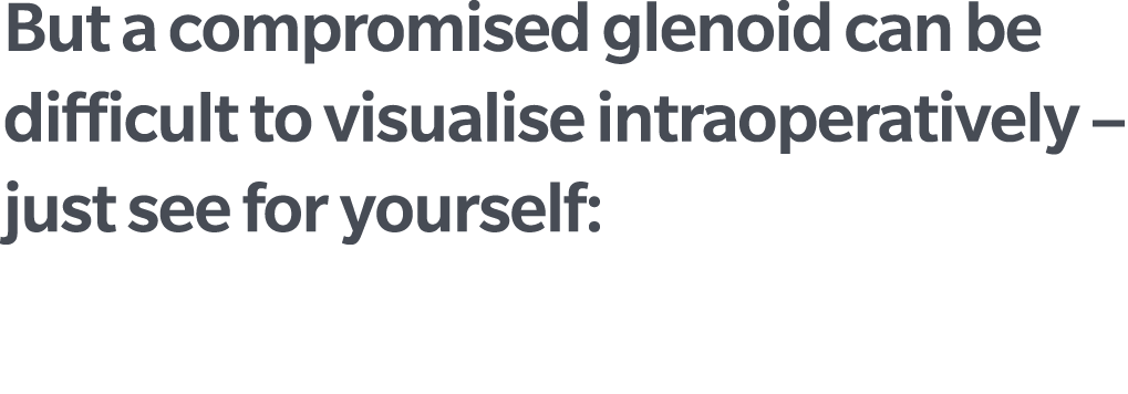 But a compromised glenoid can be difficult to visualise intraoperatively – just see for yourself: