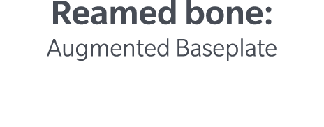 Reamed bone: Augmented Baseplate